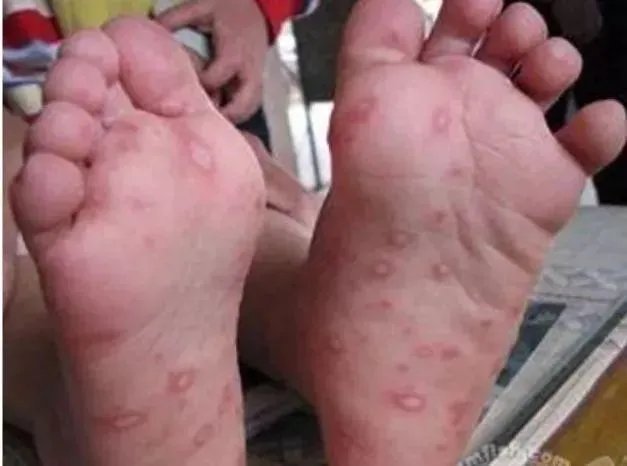 山东出现炭疽死亡病例！至少三地有人确诊，它是如何进行传播的？