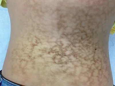 火激红斑背部纹图片