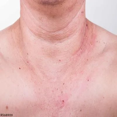 脖子里有疙瘩是什么原因