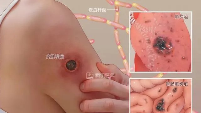 山东出现炭疽死亡病例！至少三地有人确诊，它是如何进行传播的？