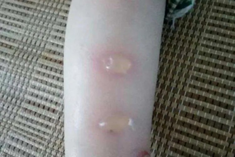 小儿痒疹症状图片