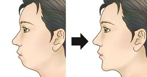 假体隆下巴价格