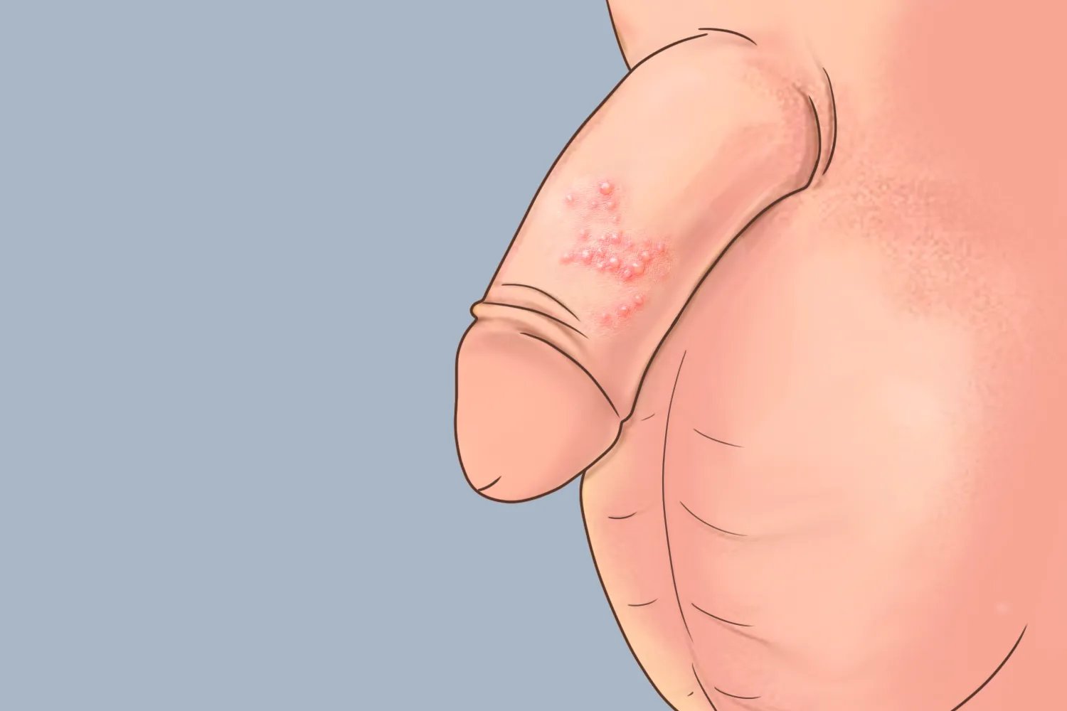 包皮珍珠疹图片