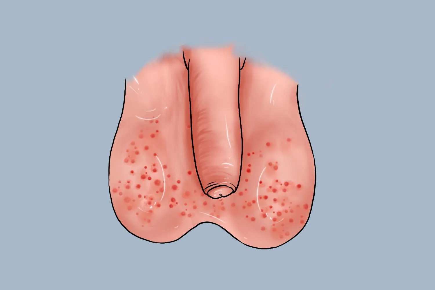 男性阴虱早期图片