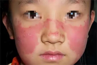 红斑狼疮蝶形红斑图片