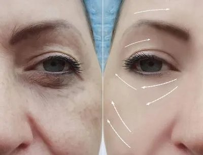 眼角纹怎样去除 8妙招助女性去除眼角纹