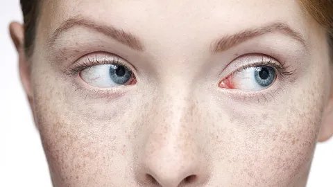 去除雀斑多少钱