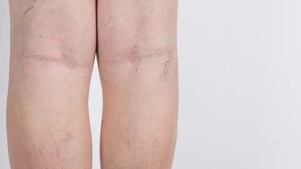 静脉曲张的治疗