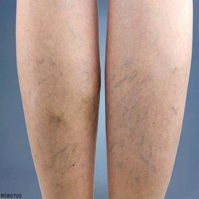 鸡皮疙瘩皮肤怎么形成的