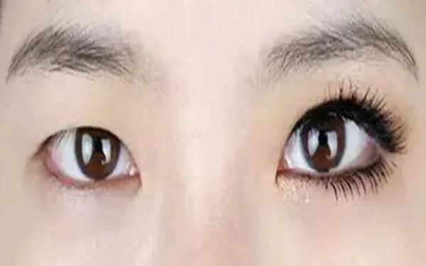 上海双眼皮手术价格