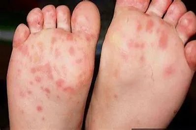 手足口病图片