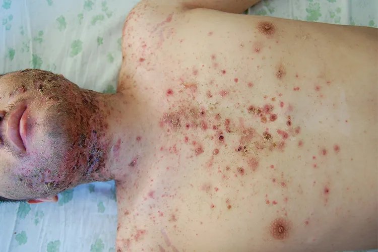 怎么判断自己痘痘的类型图片