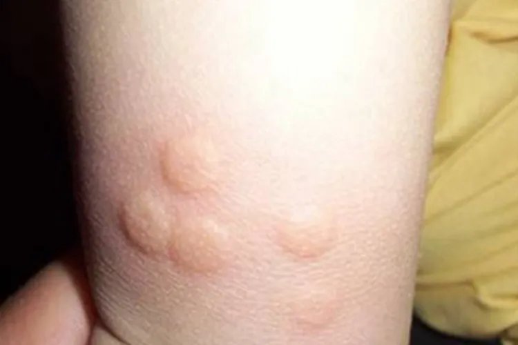 小儿痒疹症状图片