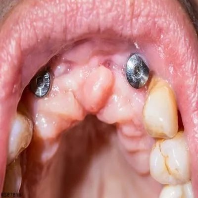 种植牙掉了还能再种吗 关于种植牙3个认识要正确