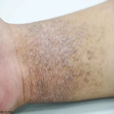 醋蛋归元液能治疗牛皮癣吗