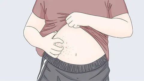 药疹多久能够恢复