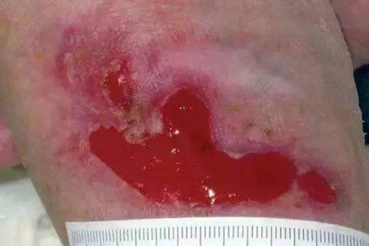 伤口肉芽增生图片