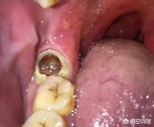 最后一颗大牙坏了一个洞，现在牙龈好痛，该怎么办呢？