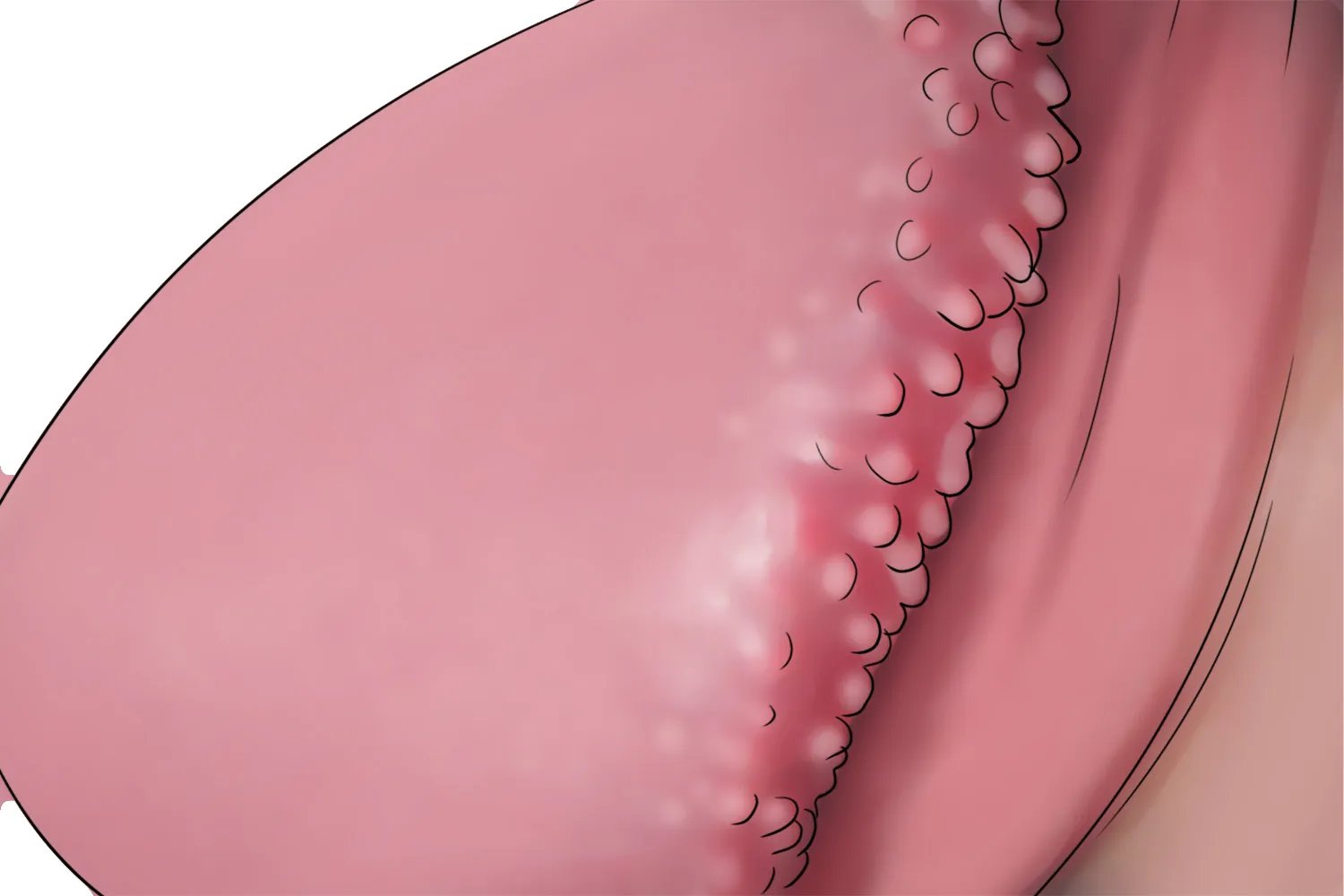 包皮珍珠疹图片