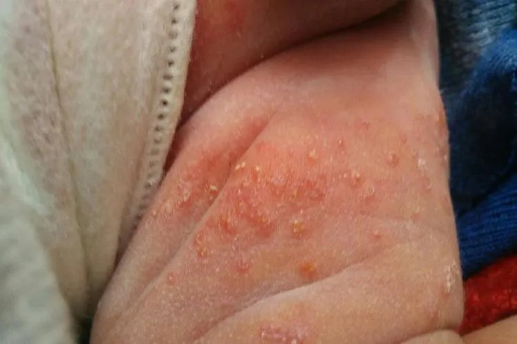 大腿内侧长了好多红色点点图片