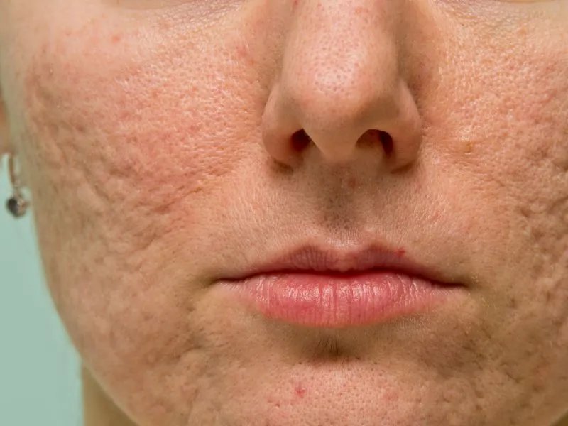 汗毛孔粗大怎么办