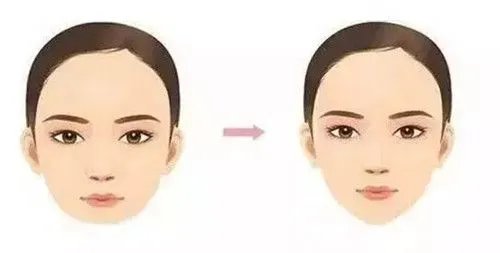 假体隆下巴价格