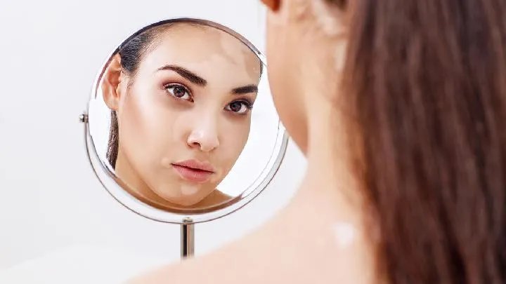 白癜风会遗传吗？