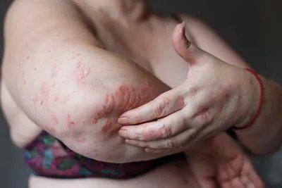 皮肤对紫外线过敏怎么办