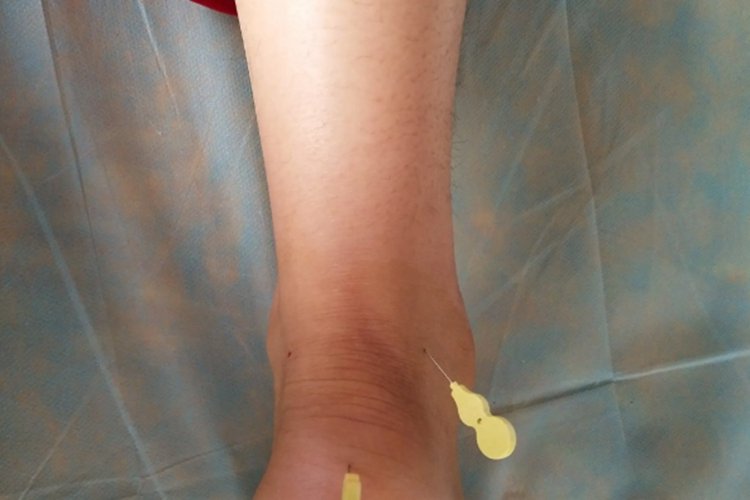 什么是跟腱炎有什么症状图片