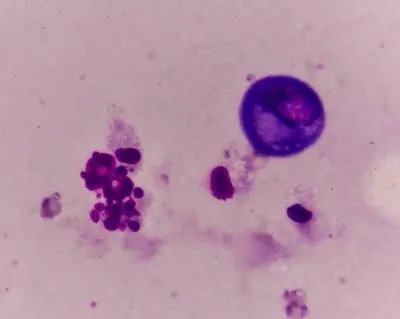 男性泌乳素瘤很严重吗