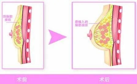 做自体脂肪隆胸的怎么样？