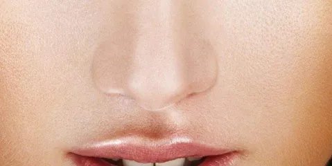 玻尿酸去法令纹的好处