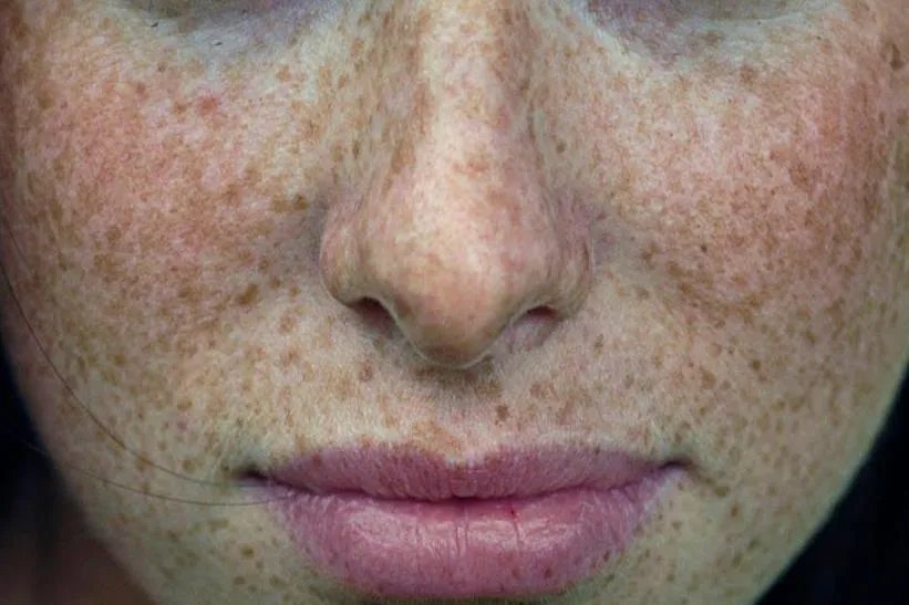 黄雀斑和黄褐斑图片