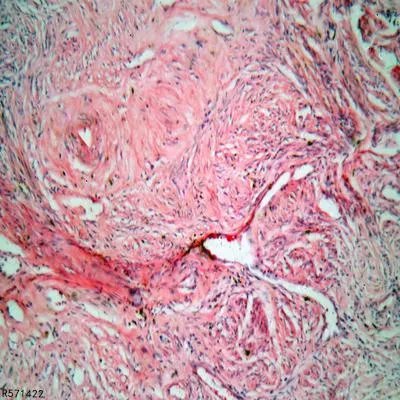 怎样预防卵泡发育不良