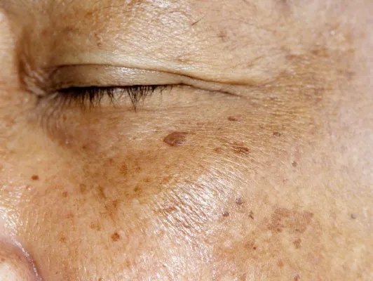 脸上长黄褐斑怎么调理