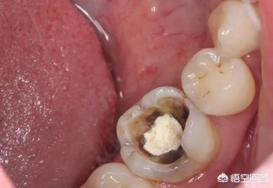 最后一颗大牙坏了一个洞，现在牙龈好痛，该怎么办呢？