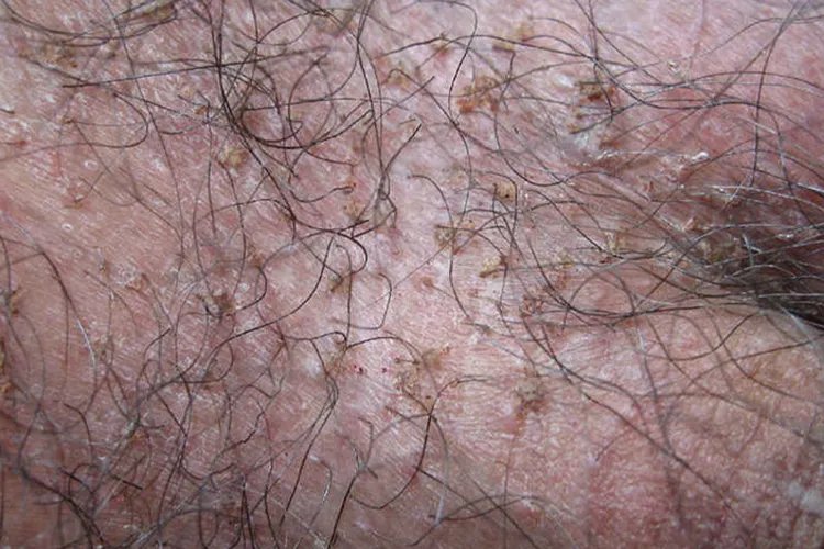 男性阴虱早期图片