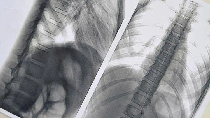 肺气肿医院该如何选择