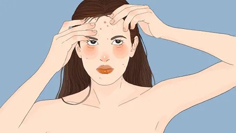 女孩脸上长痘痘是怎么回事