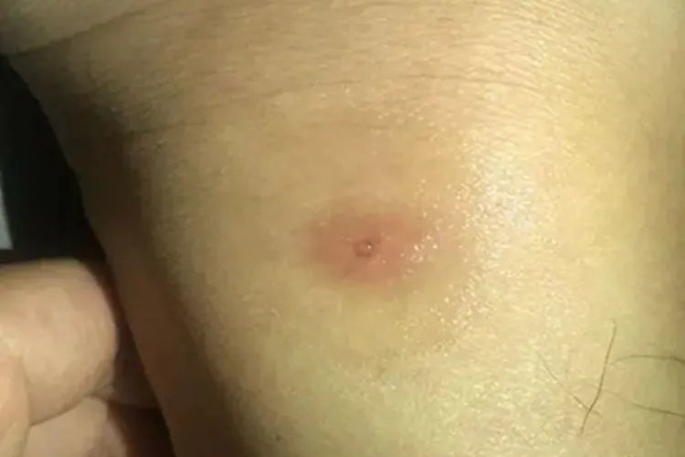 蜱咬伤症状图片